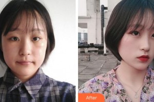 寧波市北侖區(qū)人民醫(yī)院眼科汪曉宇整形價格表附激光去眼袋案例展示