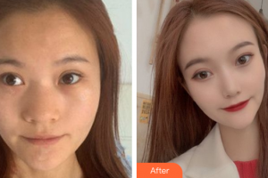 深圳瑞芙臣醫(yī)療美容門診部劉顏顏整形價格表附鼻部手術(shù)案例展示