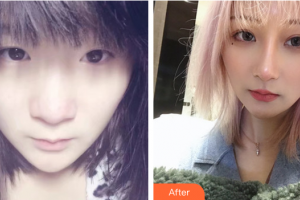 深圳麗港麗格醫(yī)療美容門診部謝俊整形價格表附隆鼻案例展示