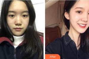 寧波市北侖區(qū)人民醫(yī)院眼科酈惠燕整形價格表附眼部綜合案例展示