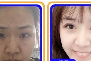 寧波市北侖區(qū)人民醫(yī)院眼科董楓整形價格表附眼部綜合案例展示