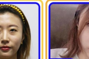 寧波市北侖區(qū)人民醫(yī)院眼科盧紅整形價格表附眼部綜合案例展示