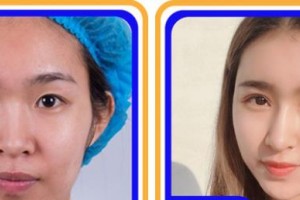 寧波愛爾光明眼科醫(yī)院金贛英整形價格表附眼部綜合案例展示