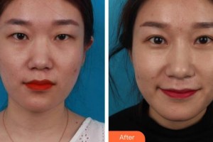 寧波市北侖區(qū)人民醫(yī)院眼科孫雯整形價格表附切開雙眼皮案例展示