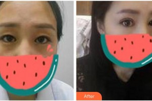 寧波愛爾光明眼科醫(yī)院李小萍整形價格表附切開雙眼皮案例展示