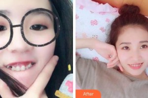 寧波牙博士口腔醫(yī)院劉清陽整形價格表附牙齒隱形矯正案例展示