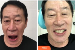 寧波牙博士口腔醫(yī)院武文東整形價格表附種植牙案例展示