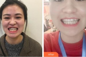 寧波現(xiàn)代口腔醫(yī)院孫丹飛整形價(jià)格表附牙齒隱形矯正案例展示