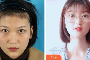 寧波市眼科醫(yī)院袁建樹(shù)整形價(jià)格表附內(nèi)切祛眼袋案例展示