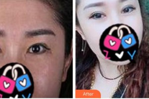 寧波市眼科醫(yī)院陳蔚整形價(jià)格表附眼部修復(fù)案例展示