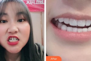 寧波千口百惠口腔門(mén)診部張玉濤整形價(jià)格表附瓷貼面案例展示