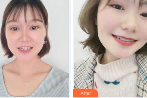 寧波鄞州協(xié)禾口腔醫(yī)院連麗琴整形價(jià)格表附隱形托槽矯正案例展示