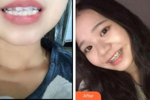 寧波鄞州協(xié)禾口腔醫(yī)院李燕娜整形價(jià)格表附金屬托槽矯正案例展示