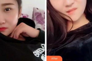 寧波鄞州協(xié)禾口腔醫(yī)院王昭文整形價(jià)格表附根管調(diào)節(jié)案例展示