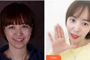 寧波鄞州德中口腔門(mén)診部何澤紅整形價(jià)格表附隱形托槽矯正案例展示