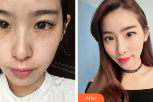 深圳麗港麗格醫(yī)療美容門診部易仁祥整形價格表附激光祛斑案例展示