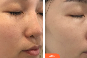 深圳韓佳醫(yī)療美容門診部王煥英整形價格表附多方面部較準(zhǔn)祛斑案例展示