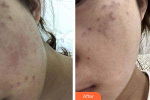 深圳春天海岸醫(yī)療美容門診部李康勇整形價格表附蜂巢激光美膚祛斑案例展示