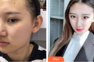 深圳韓佳醫(yī)療美容門診部周爽整形價格表附面部吸脂瘦臉案例展示