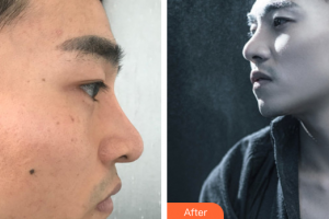 深圳韓佳醫(yī)療美容門診部文中華整形價(jià)格表附硅膠下巴案例展示