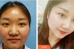 深圳博愛醫(yī)院整形美容中心許國(guó)明整形價(jià)格表附鼻部手術(shù)案例展示