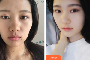 深圳鵬程醫(yī)院整形美容中心韓守義整形價(jià)格表附熱瑪吉案例展示