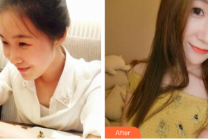 深圳鵬程醫(yī)院整形美容中心呂一斌整形價(jià)格表附熱瑪吉多方面部體驗(yàn)案例展示