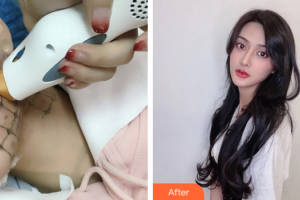 深圳鵬程醫(yī)院整形美容中心李莉婷整形價(jià)格表附熱瑪吉案例展示