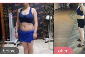 深圳鵬程醫(yī)院整形美容中心王君整形價(jià)格表附針灸瘦身案例展示