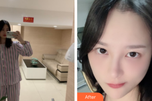 深圳鵬程醫(yī)院整形美容中心林彩萍整形價(jià)格表附種植發(fā)際線案例展示