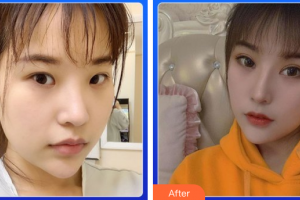 深圳美加美醫(yī)療美容門診部陳群整形價(jià)格表附雙眼皮案例展示