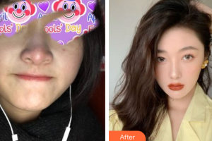 深圳百合醫(yī)療美容門診部姚堯整形價(jià)格表附自體肋骨隆鼻案例展示