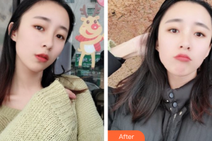 深圳百合醫(yī)療美容門診部付淑蘭整形價(jià)格表附美白嫩膚案例展示