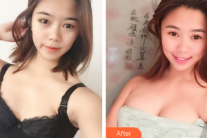 深圳韓美爾醫(yī)療美容門診部楊維琦整形價(jià)格表附自體脂肪隆胸案例展示