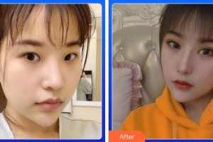 寧波藝星整形美容醫(yī)院朱繼鋒整形價(jià)格表附切開(kāi)雙眼皮案例展示