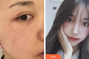 寧波藝星整形美容醫(yī)院崔晶瑩整形價(jià)格表附激光美膚激光案例展示