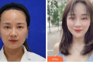 寧波澳瑪星光醫(yī)療美容診所唐田整形價(jià)格表附激光祛斑案例展示