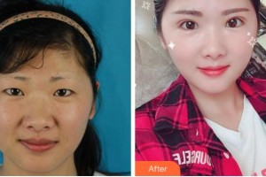 溫州和平整形醫(yī)院周健整形價(jià)格表附切開雙眼皮案例展示