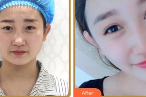 溫州和平整形醫(yī)院郭光燁整形價(jià)格表附眼部綜合案例展示