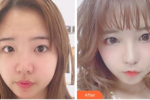 溫州和平整形醫(yī)院劉照文整形價(jià)格表附眼部綜合案例展示