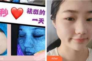 溫州同德醫(yī)院整形美容中心盧麗萍整形價(jià)格表附激光祛斑案例展示