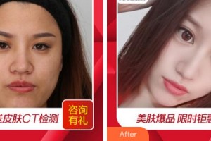 溫州芘麗芙美容醫(yī)院馮琳整形價(jià)格表附淡斑美白案例展示