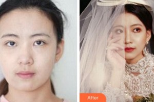 溫州藝星醫(yī)學(xué)美容醫(yī)院曾文尚整形價(jià)格表附熱瑪吉案例展示