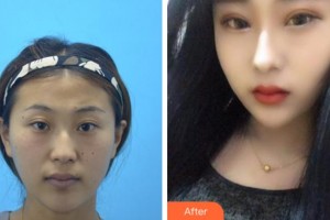 溫州藝星醫(yī)學(xué)美容醫(yī)院張至德整形價(jià)格表附切開雙眼皮案例展示