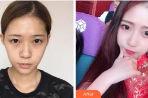 溫州藝星醫(yī)學(xué)美容醫(yī)院賀忠波整形價(jià)格表附眼部綜合案例展示