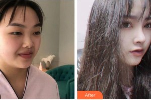 溫州藝星醫(yī)學(xué)美容醫(yī)院新倉辛一整形價(jià)格表附術(shù)前眼皮松弛案例展示