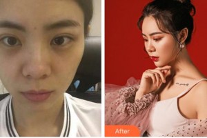 溫州藝星醫(yī)學(xué)美容醫(yī)院錢輝整形價(jià)格表附眼部修復(fù)案例展示