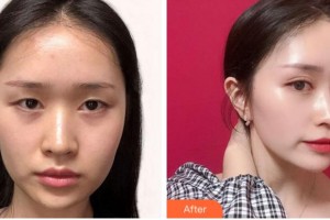 溫州藝星醫(yī)學(xué)美容醫(yī)院林穎新整形價(jià)格表附眼部綜合案例展示