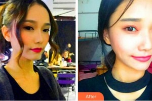 溫州藝星醫(yī)學(xué)美容醫(yī)院李杰整形價(jià)格表附熱瑪吉案例展示