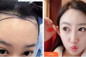 溫州伊美爾加禾植發(fā)診所呂輝整形價(jià)格表附種植發(fā)際線案例展示